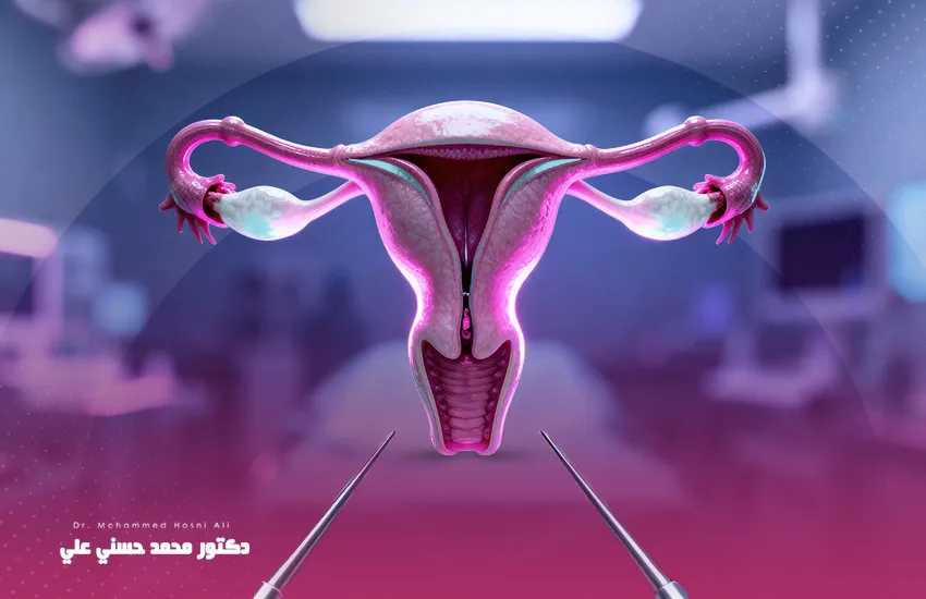 عملية استئصال الرحم بالمنظار